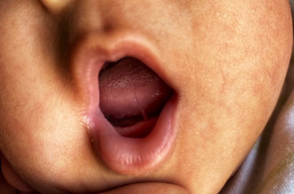 Lip Tie Treatment: When To Wait, And When To Be Proactive